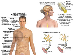 multiple sclerosis symptoms, caregiver support, Symptometry, natural health, root cause therapeutics